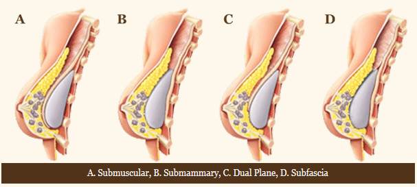 Breast surgery incisions - A.Submuscular, B.Submammary, C.Dual Plane, D.Subfascia Breast surgery incisions - Submuscular, Submammary, Dual Plane, Subfascia