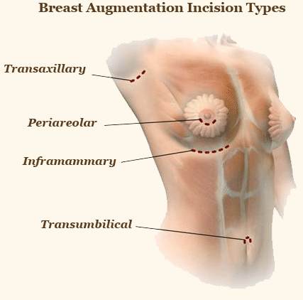 Breast enlargement surgery incision types Breast enlargement surgery incision types