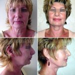 Facelift-necklift1