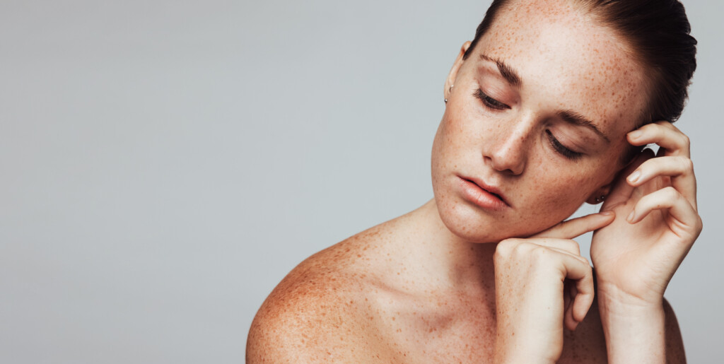 hyper pigmentation